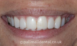 After Composite Bonding Treatment