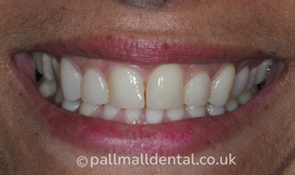 Before Composite Bonding Treatment